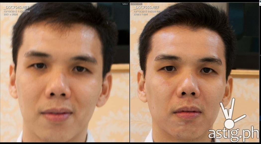 Before (left) and after (right) Luminisce Baby Skin Laser anti-aging treatment