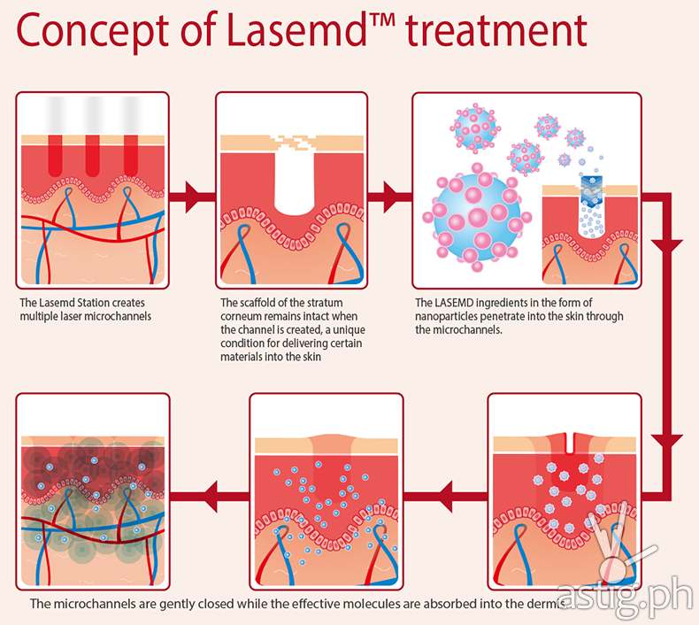 Lutronic LaseMD Infographic