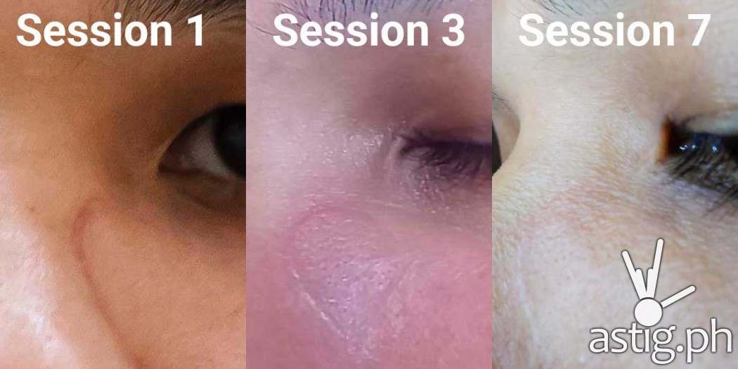 Photos showing the progression of laser scar removal treatment after 7 sessions