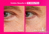 Skin treatment promises smoother skin in 15 minutes – here’s how it works