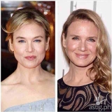 Top plastic surgeon explains why Renee Zellweger looks different