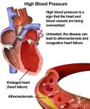 14 million Filipinos suffer from Hypertension – DOH